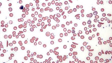 Sickle_Cell_Blood_Smear.JPG